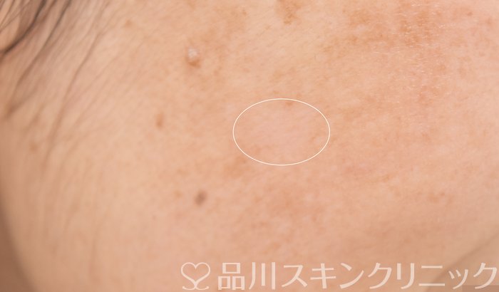症例NO.64702のAFTER写真