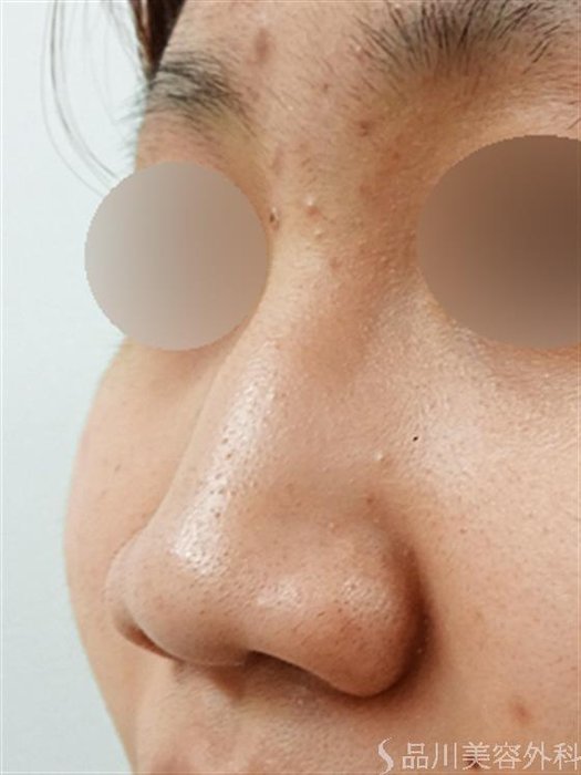 症例NO.34435のBEFORE写真