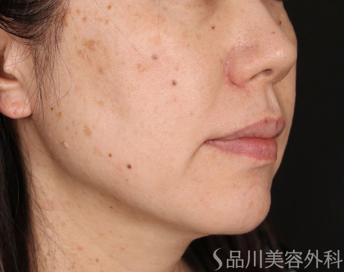 症例NO.72124のBEFORE写真