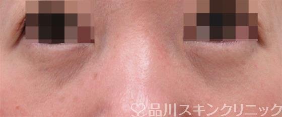 症例NO.33491のAFTER写真