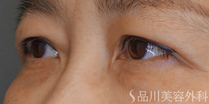 症例NO.68199のAFTER写真