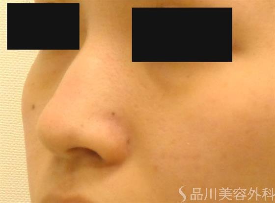 症例NO.39511のBEFORE写真