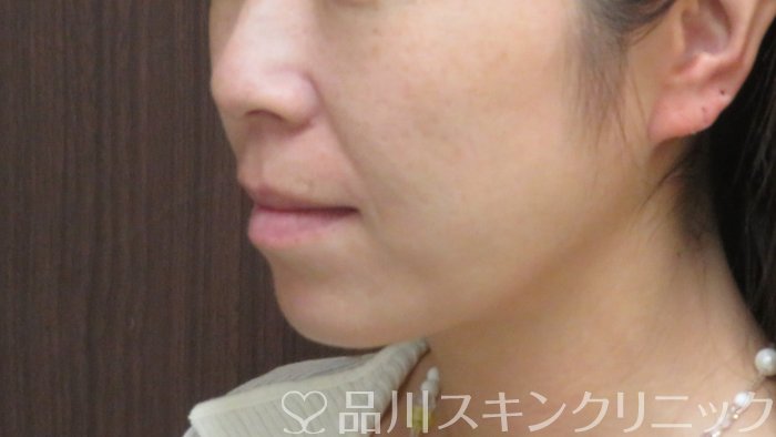 症例NO.72170のBEFORE写真