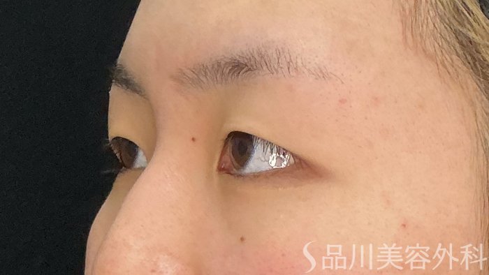 症例NO.72141のBEFORE写真