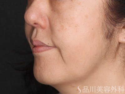 症例NO.72074のBEFORE写真