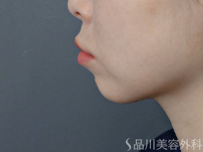 症例NO.72584のBEFORE写真