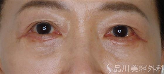 症例NO.56833のAFTER写真