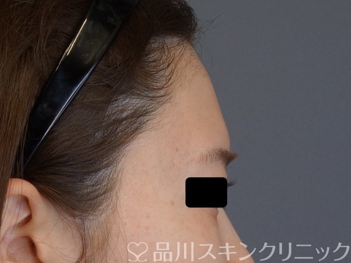 症例NO.74516のBEFORE写真