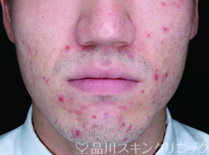 症例NO.74024のBEFORE写真