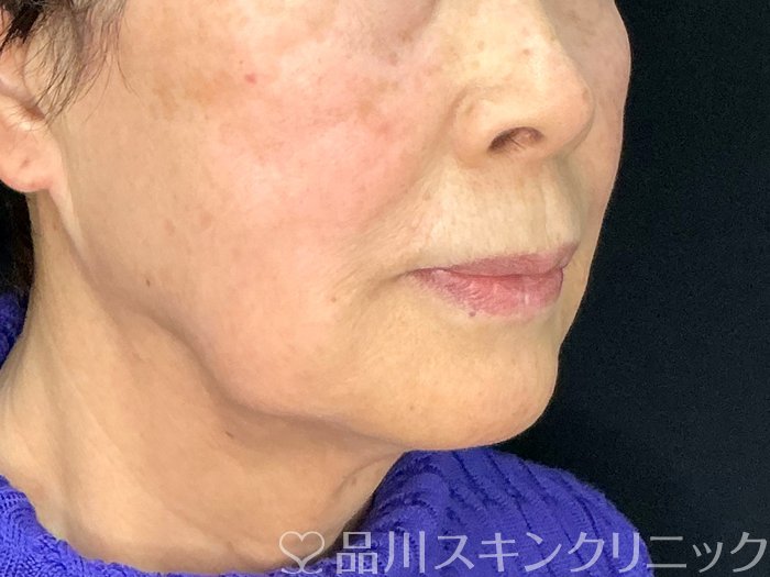 症例NO.73212のBEFORE写真