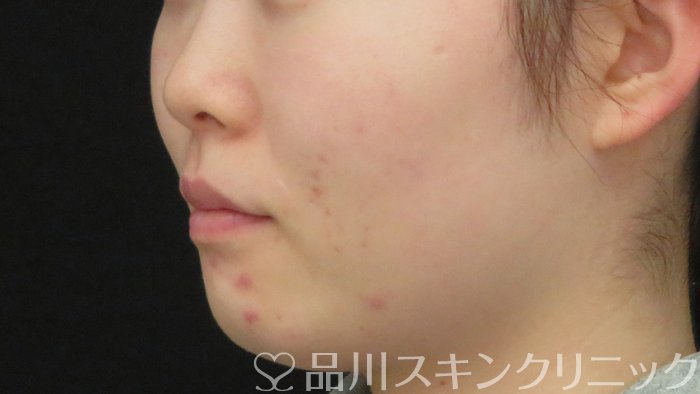 症例NO.72051のBEFORE写真