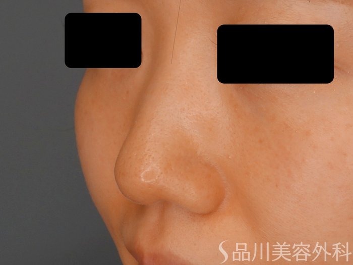症例NO.62095のBEFORE写真