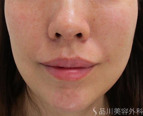 症例NO.43081のAFTER写真