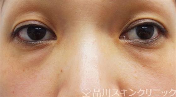 症例NO.33860のBEFORE写真