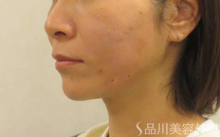 症例NO.72427のAFTER写真