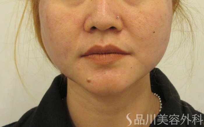 症例NO.72165のAFTER写真