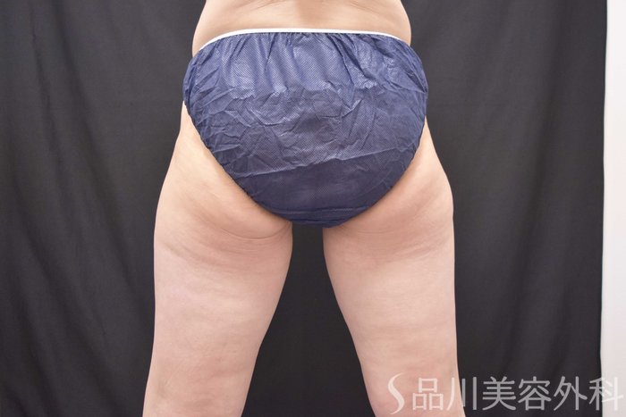 症例NO.66893のBEFORE写真