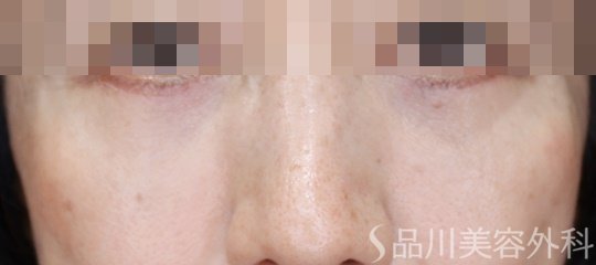 症例NO.72556のAFTER写真