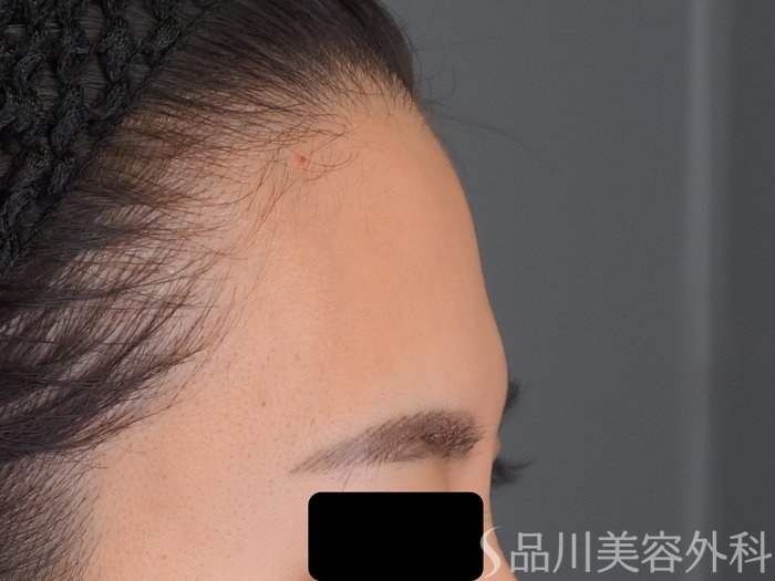 症例NO.69696のBEFORE写真