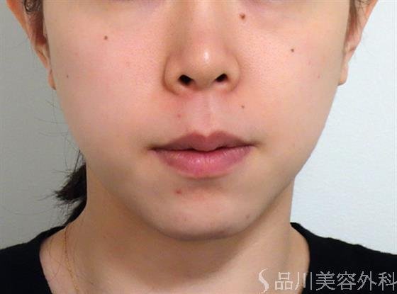 症例NO.27578のBEFORE写真