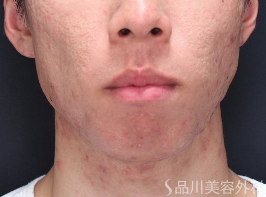 症例NO.72982のBEFORE写真