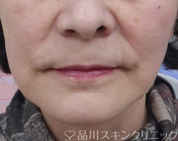 症例NO.69343のAFTER写真
