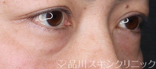 症例NO.73218のBEFORE写真