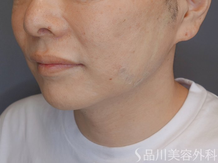 症例NO.70338のAFTER写真