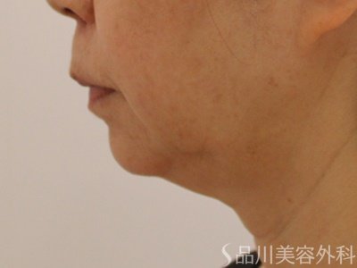 症例NO.73443のBEFORE写真