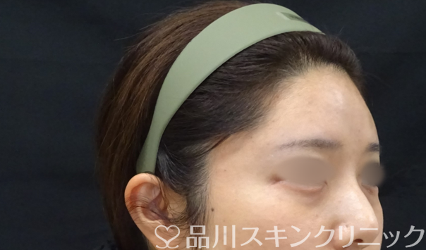症例NO.69409のAFTER写真