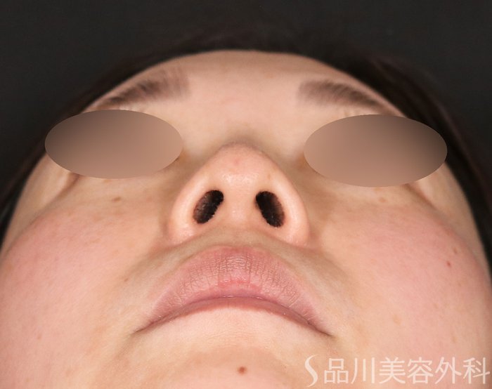 症例NO.72957のAFTER写真