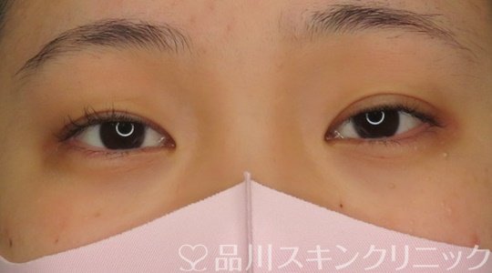 症例NO.71090のBEFORE写真