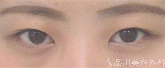 症例NO.22683のBEFORE写真