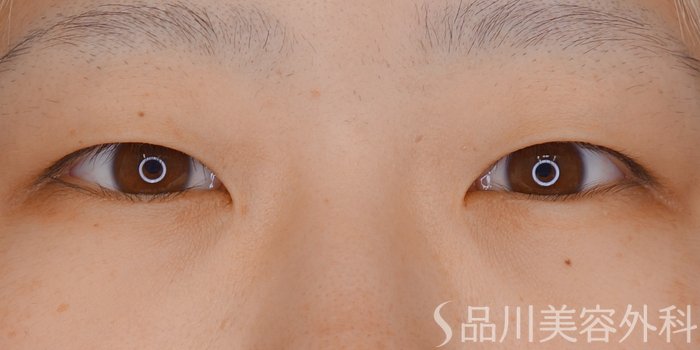 症例NO.71829のBEFORE写真