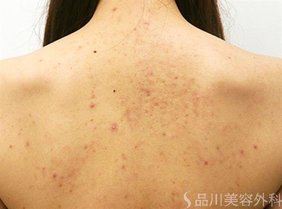 症例NO.23670のBEFORE写真