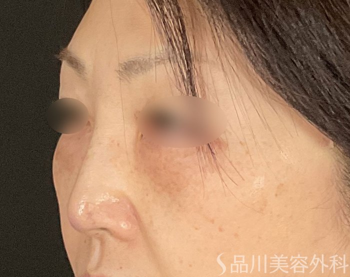 症例NO.74547のAFTER写真