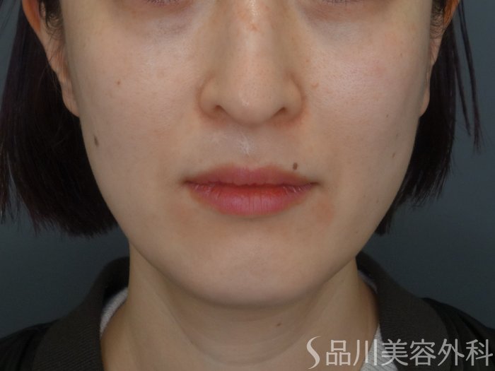 症例NO.74588のBEFORE写真