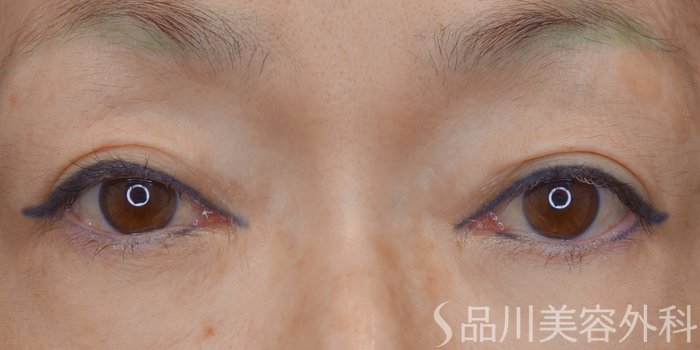 症例NO.67930のBEFORE写真