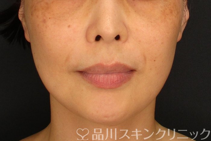 症例NO.73491のAFTER写真