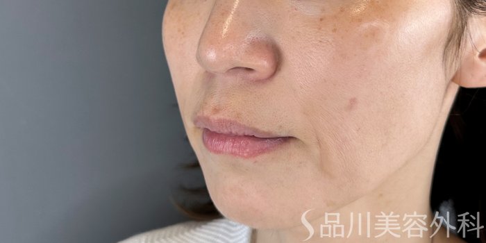 症例NO.70175のBEFORE写真