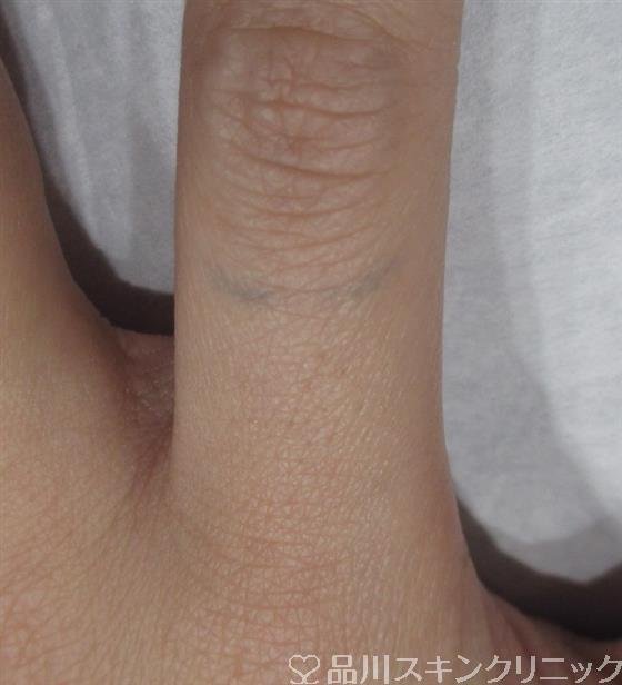 症例NO.33966のBEFORE写真