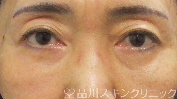 症例NO.69385のAFTER写真
