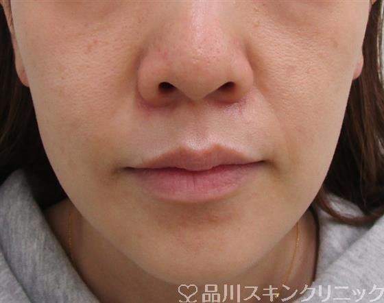 症例NO.39601のBEFORE写真