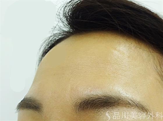 症例NO.39615のBEFORE写真