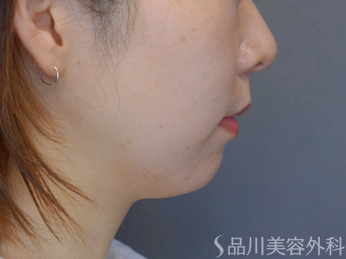 症例NO.74004のBEFORE写真