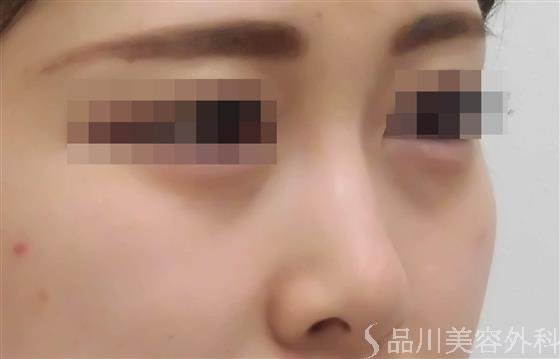 症例NO.38356のBEFORE写真