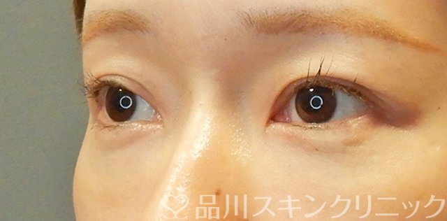 症例NO.67709のBEFORE写真