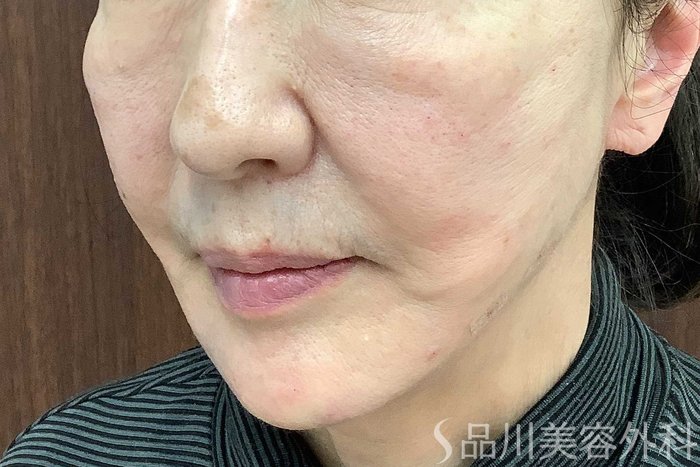 症例NO.62923のAFTER写真
