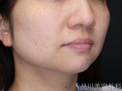 症例NO.64970のBEFORE写真