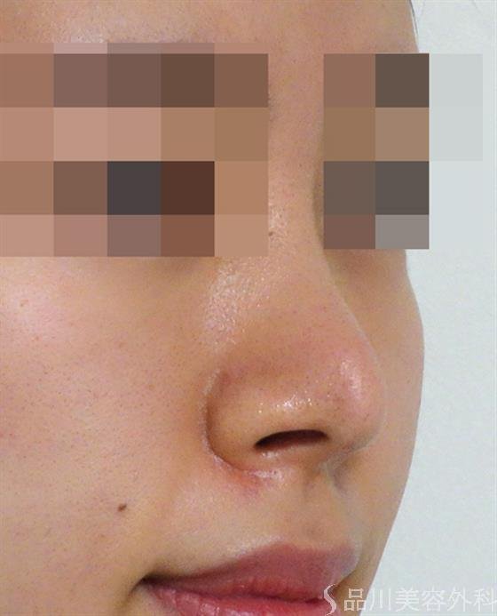 症例NO.47081のAFTER写真